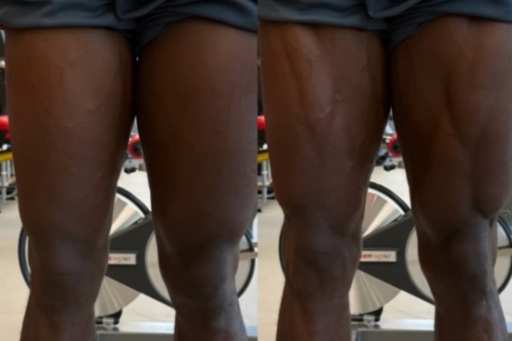 重傷歸來(lái)！阿方索曬照自己腿部的變化，輕松練出肌肉